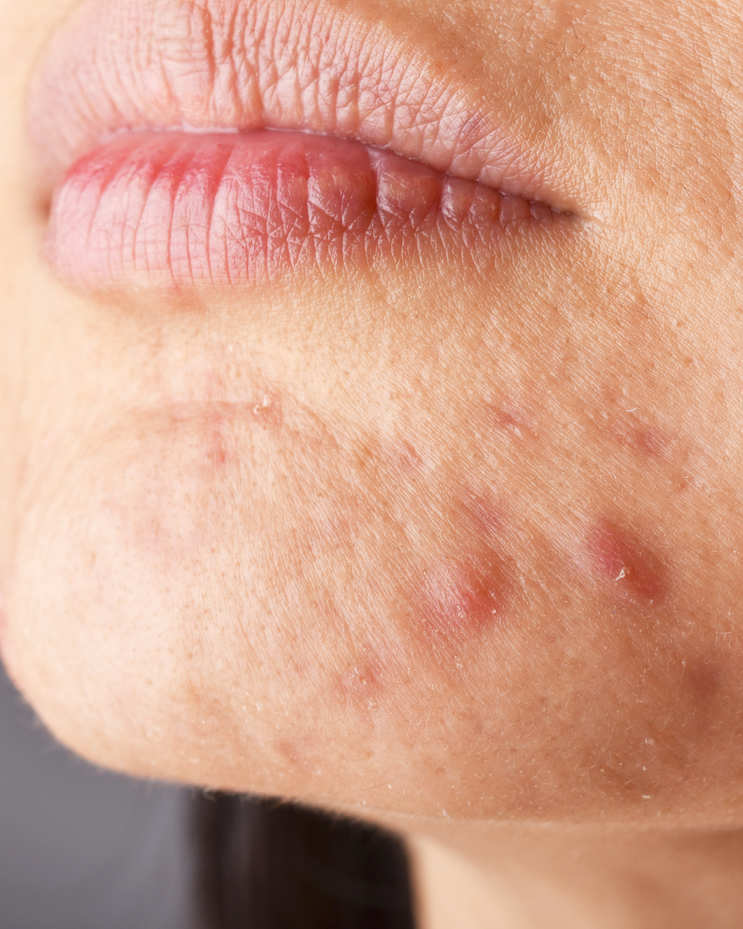 Say Goodbye to Breakouts:  A Simple Guide to Understanding and Treating Acne Naturally